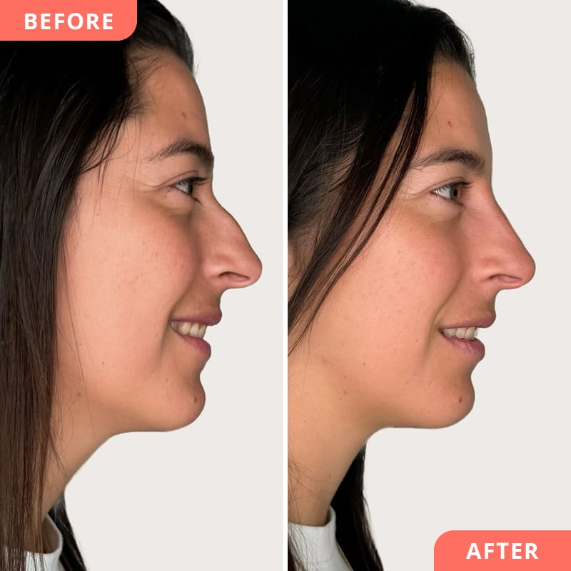 Vorher-Nachher Collage einer Hyaluronsäure-Nasenkorrektur bei Beauty2Go – sanfte Begradigung der Nase durch Korrektur des Nasenhöckers ohne Operation