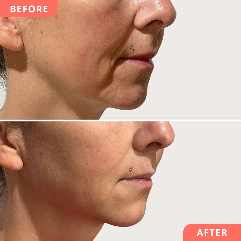 Vorher-Nachher Collage einer Nasolabialfalten-Unterspritzung mit Hyaluronsäure bei Beauty2Go – aufgefüllte Falten für frischeres, jugendliches Aussehen