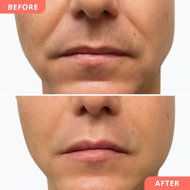 Vorher-Nachher Collage einer Hyaluron-Behandlung bei Beauty2Go – Nasolabialfalten-Korrektur für frischeres, jugendlicheres Aussehen beim Mann