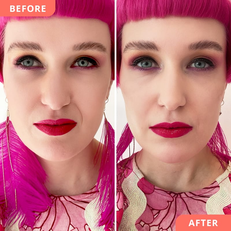 Vorher-Nachher Bild einer Nasolabialfalten-Unterspritzung mit Hyaluronsäure – Ausgleich für mehr Symmetrie und harmonisches Gesamtbild