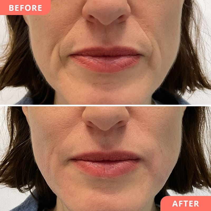 Vorher-Nachher Collage bei Beauty2Go – Hyaluronsäure-Behandlung füllt Nasolabialfalten auf und sorgt für jugendliche Frische