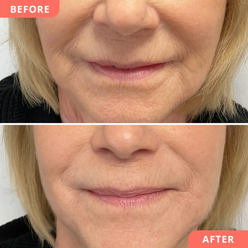 Vorher-Nachher Vergleich einer Hyaluron-Unterspritzung – Reduktion der Nasolabialfalten für vitales, erholtes Erscheinungsbild