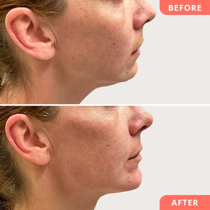 Beauty2Go Vorher-Nachher Bild – Hyaluron-Wangenaufbau für frisches Aussehen und klar definierte Gesichtskonturen