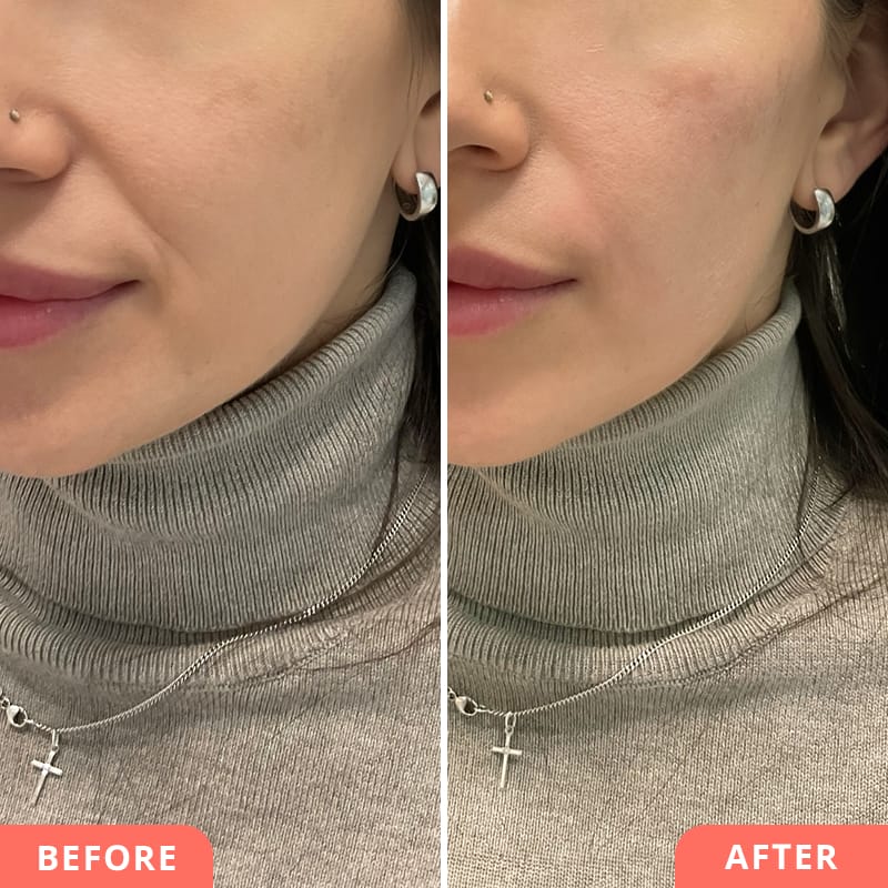 Vorher-Nachher Collage einer Wangenunterspritzung mit Hyaluronsäure bei Beauty2Go – harmonischere Gesichtsform und reduzierte Nasolabialfalte