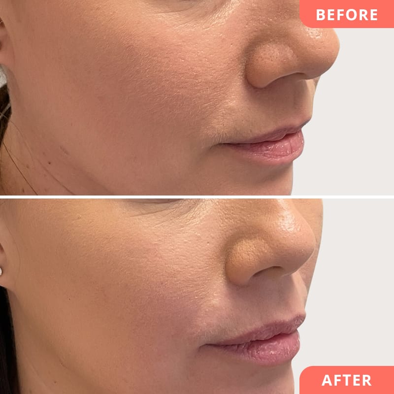 Vorher-Nachher Collage einer Wangenkorrektur mit Hyaluronsäure – betontes Profil und jugendliche Frische im Gesicht