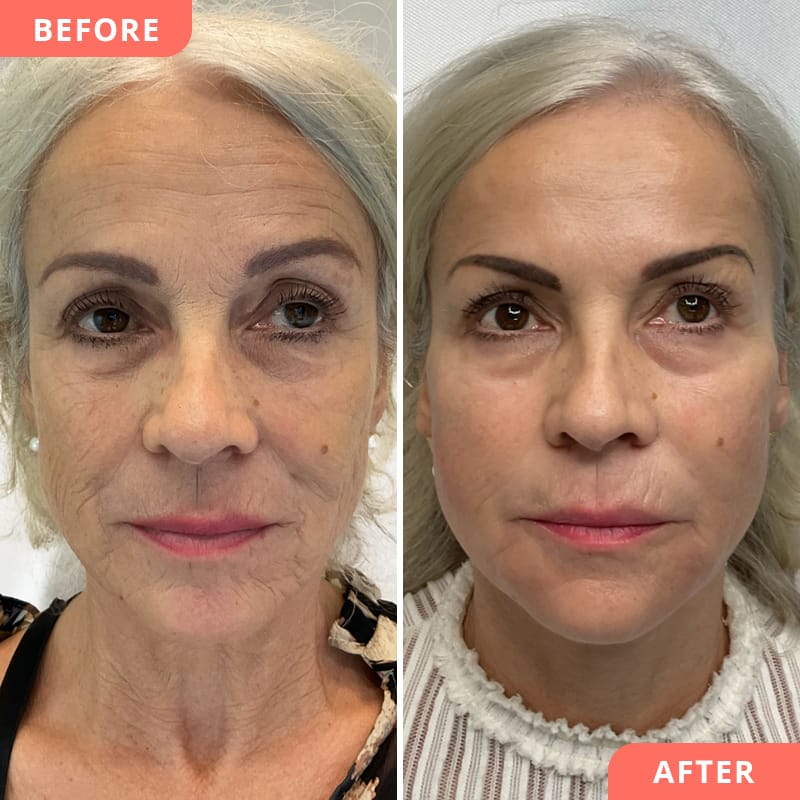 Vorher-Nachher Ergebnis von einer Kombi-Behandlung aus Wangen, Nasolabialfalten, Kinnkorrektur und Marionettenfalten für mehr Frische und jugendliches Aussehen bei Beauty2Go