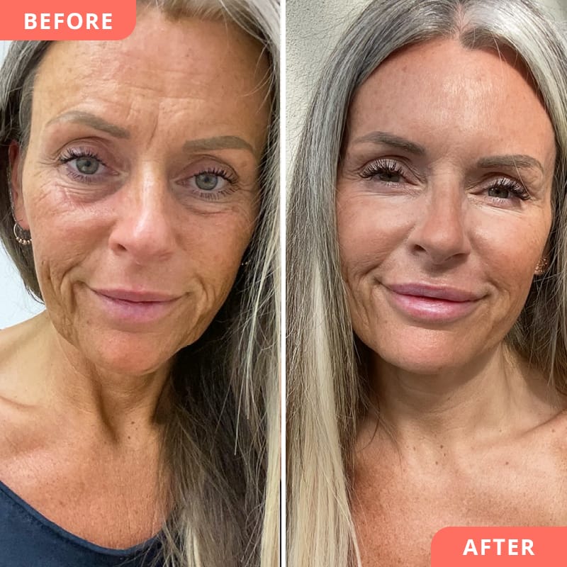 Vorher-Nachher Ergebnis von einer Anti-Aging Kombi-Behandlung mit Profhilo und Hylauronsäure an Wangen, Augenringen, Lippen und Kinn für mehr Frische und jugendliches Aussehen bei Beauty2Go