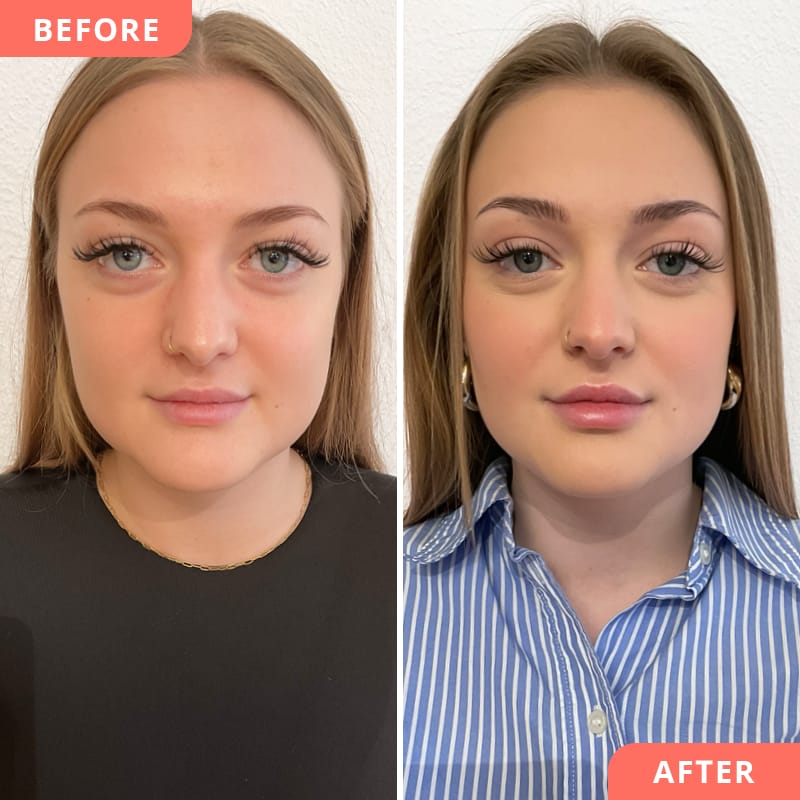 Vorher-Nachher Ergebnis von Full-Face-Behandlung bei Beauty2Go mit Hylauronsäure an Lippen, Kinn, Wangen und Nase für mehr Glow und Symmetrie