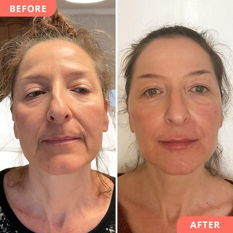 Vorher-Nachher Ergebnis von einer Anti-Aging Kombi-Behandlung mit Hylauronsäure an Wangen, Lippen, Nasolabialfalten und Marionettenfalten für mehr Frische und jugendliches Aussehen bei Beauty2Go