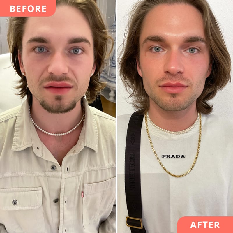 Vorher-Nachher Ergebnis von Kombi-Behandlung bei Beauty2Go mit Hyaluronsäure an Nasolabialfalten, Augenringen und Wangen für mehr Symmetrie und einen frischen Look