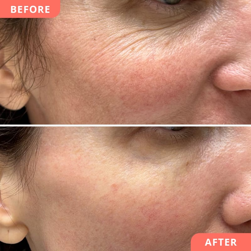 Vorher-Nachher Collage einer Beauty2Go Behandlung der Augenpartie mit Polynukleotiden – Biostimulatoren unterstützen die körpereigene Regeneration, feine Linien wirken geglättet und das Ergebnis ist ein frisches, natürliches Erscheinungsbild